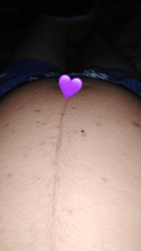 เป็นตุ่มใส่ๆแล้วคั้น