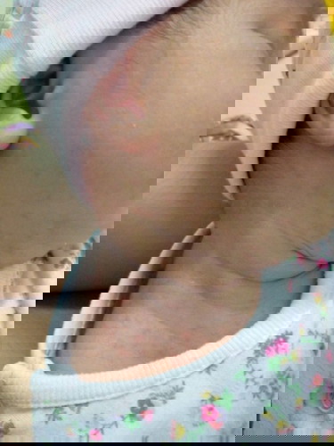น้องเป็นผื่นแดงๆ