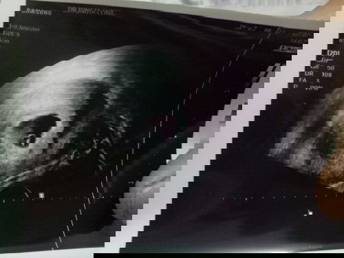 6สัปดาห์ หัวใจของหนูกระพริบแล้วนะคะ 😊😊😊