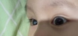 CONGENETAL CATARACT