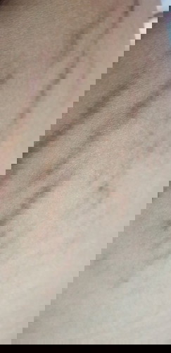 Gmn cara menghilangkan STRETCHMARK ?