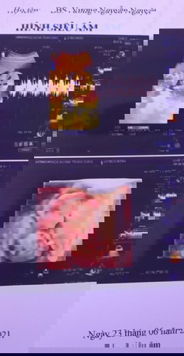 Này Mình siêu âm lúc 17w, BS khen mũi bạn ấy.😊 tương lai trầm tính giống ba