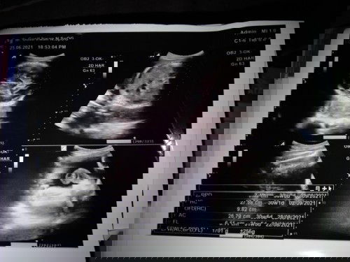 Terlilit tali pusar satu kali