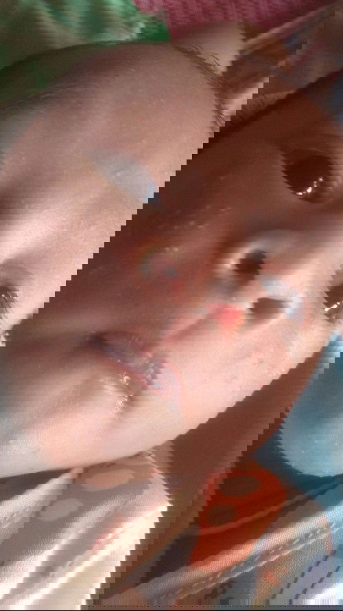 น้องเป็นผื่น ทำไงดีคะ