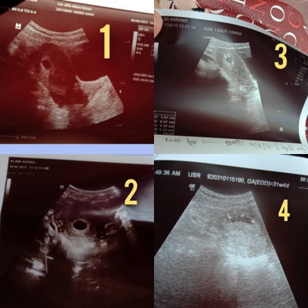 Scan 8weeks tak nampak janin