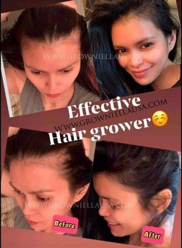 Hair loss, hair fall, white hair