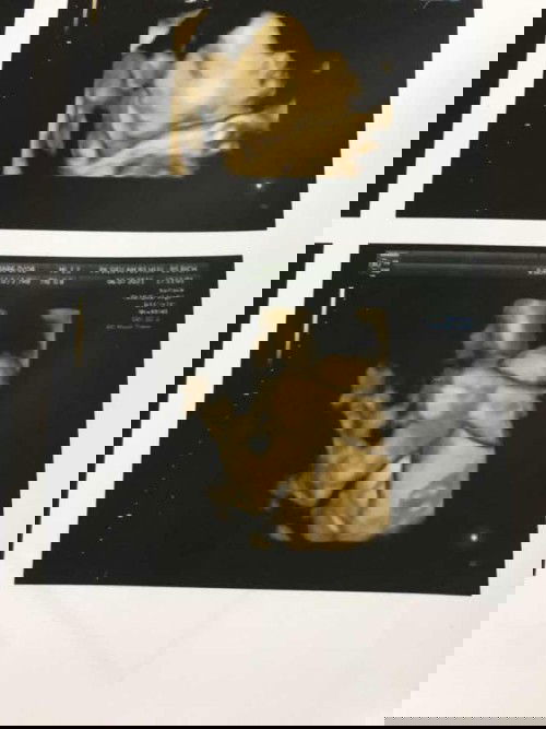 Thai lớn hơn tuổi thai