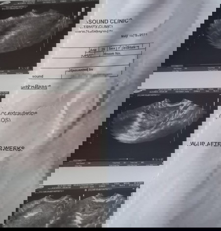 Pregnant with pcos po ako