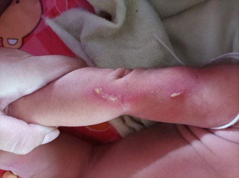 เป็นตุ่มหนอง