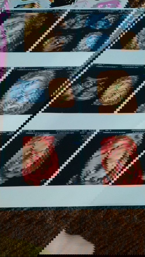 ad yg ud usg d usia 14 minggu 6 hri