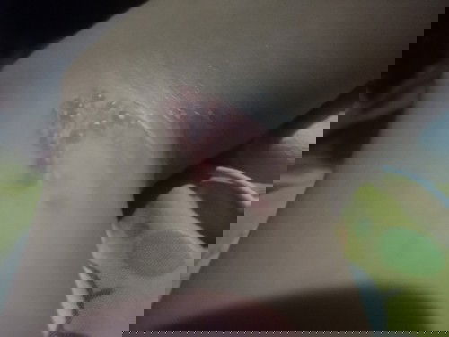 Tinabuan po ako nito parang paso na  mahapdi breastfeed po ako kay baby  di po ba masama kay baby.