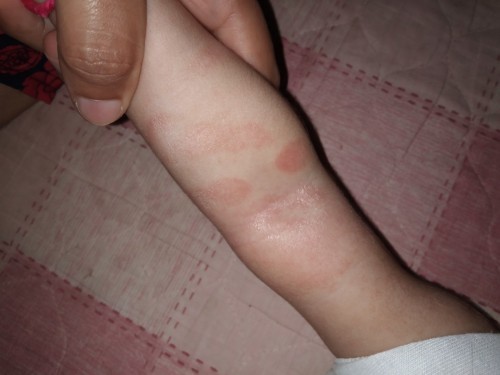 Please help me. Anu gamot ng ganitong redness sa skin ng anak ko? Kailangan ko ng sagot pls.