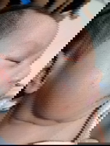 Rashes sa pisngi