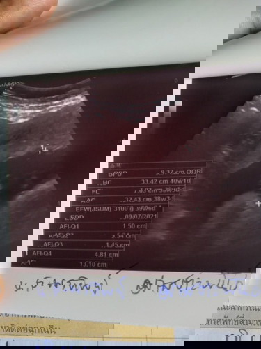 รูปอัลตราซาวด์