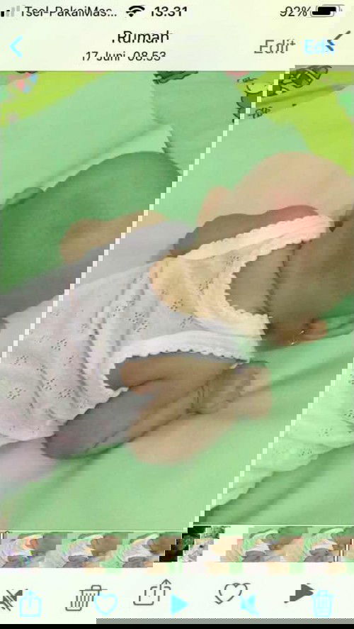 apa pengobatan untuk merah di kepala bayi?