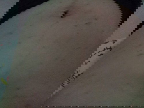 สิวขึ้นเยอะไม่หายสักที