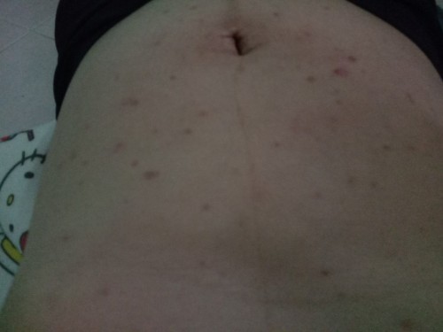 สิวขึ้นเยอะไม่หายสักที