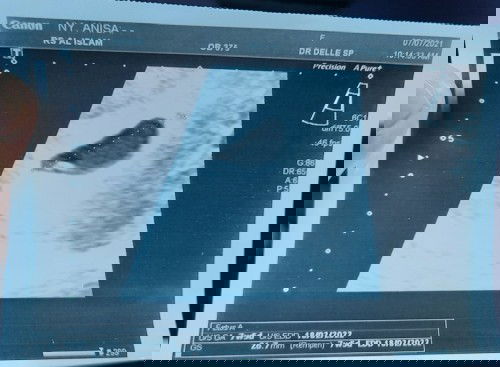 7w blm terlihat janin baru ada bakal janin dan persiapan makanan janin