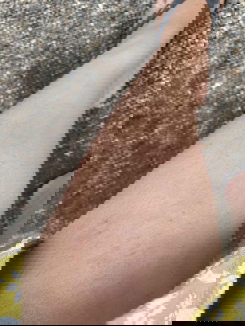 Gatal naik bintik merah