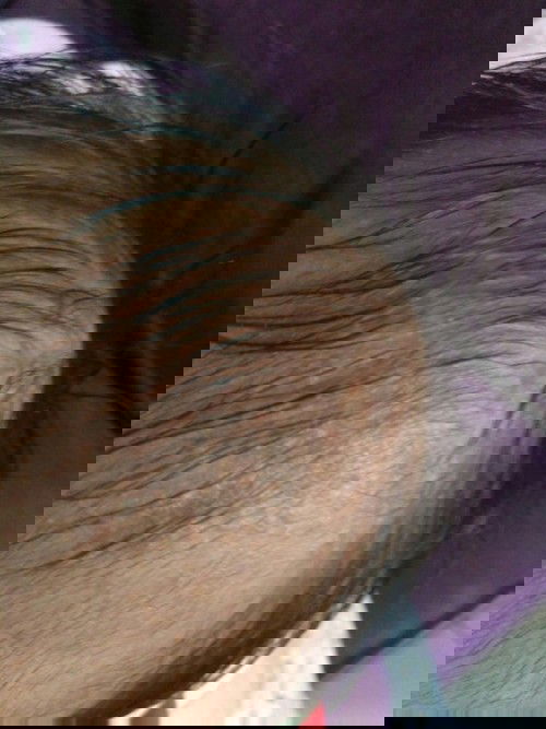 Beruntusan di kepala