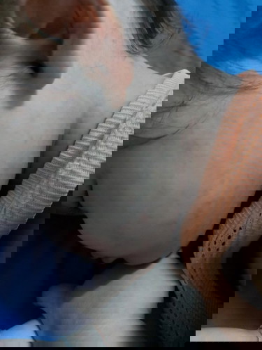 ผื่นลูกหลังมีไข้