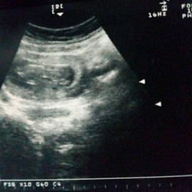 Ada yg sama ga bunda2 saya hamil 18 week tpi perutku kecil.USG waktu usia 13 week ada yg tau ga