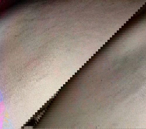 Gatal di Kehamilan TM2