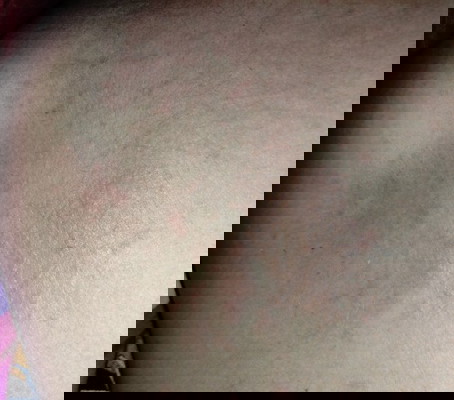 Gatal di Kehamilan TM2