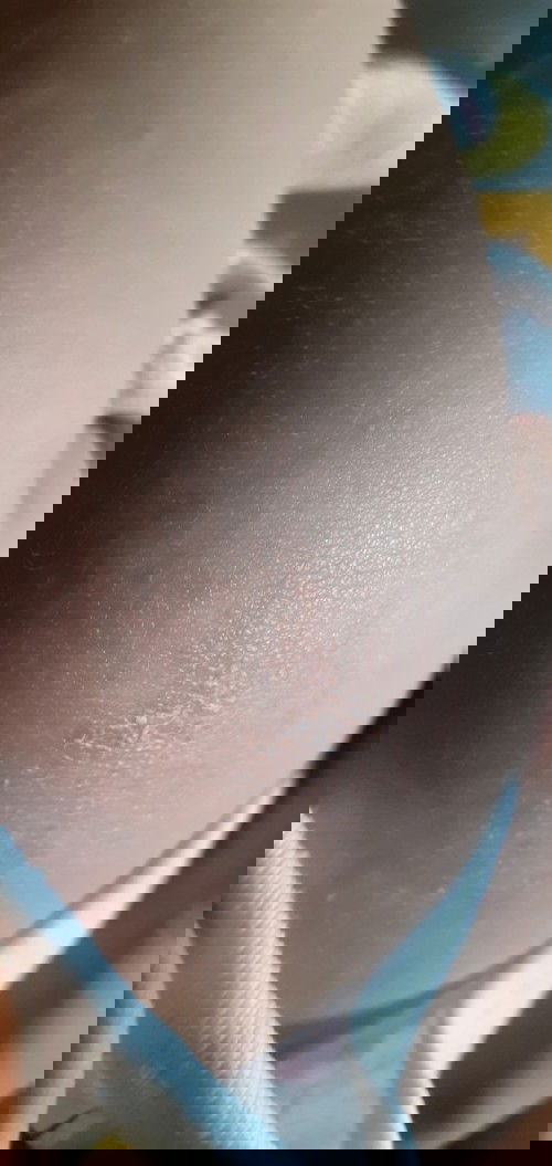 Cu Bơ nhà e bị vậy rồi dùng gì để hết ạ?