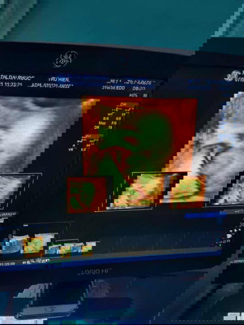 Gin được 31wd 
Cho mình hỏi có mom nào sữa non về chưa ạ. Mình gần 32w tuần mà chưa thấy có dấu hiệu gì hết