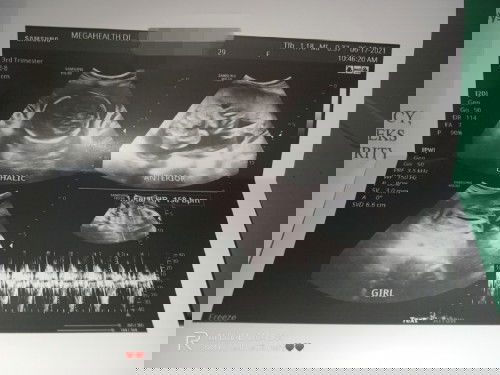 Totoo po ba pag girl Ang pinagbubuntis ndi masyado magalaw? Tapos anterior pa po ako,