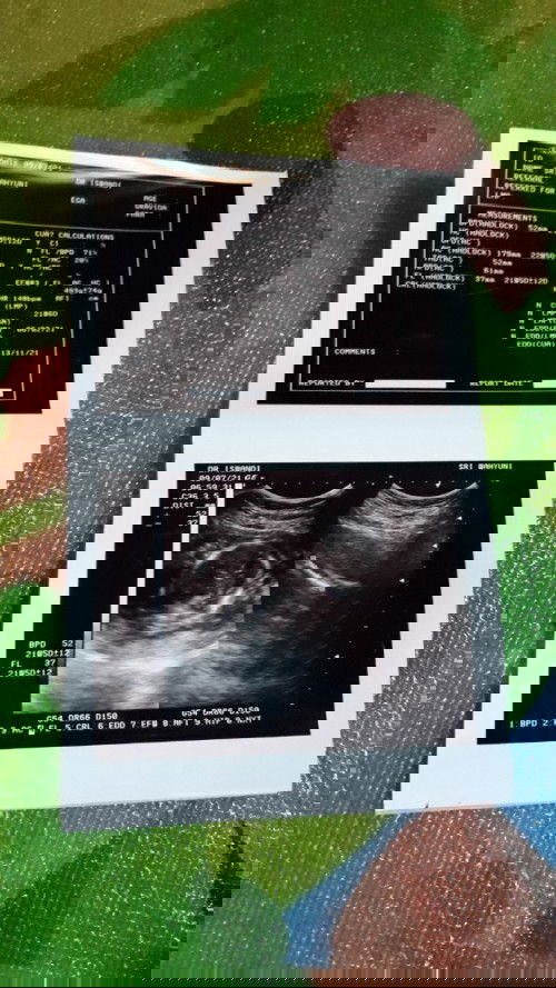 Usia kehamilan 21 minggu 6 hari belum kelihtan jenis kelaminya