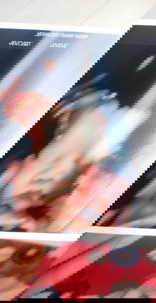 Nàng tấm 32w3d của nhà iem đây ạ,lần trước trèo lên bàn siêu âm 3 lần mà ko chụp được mẹt của ẻm.🥰