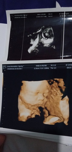 Saran Kelahiran Normal