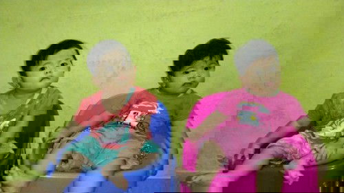 Efek Imunisasi campak