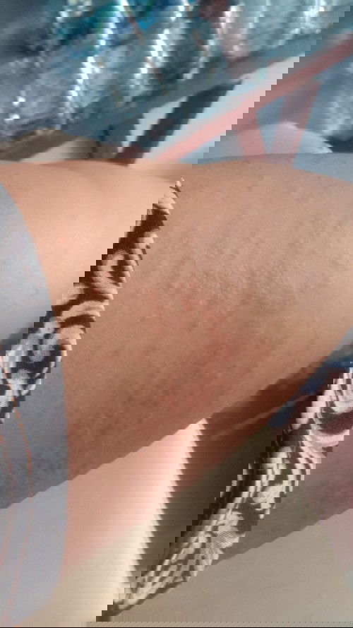 Saya hamil 34 Minggu..
Tapi perut saya gatal sekali..dan sekarang bagian tubuh saya semuanya gatal..