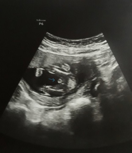 15week แบบนี้ผช.เเน่นอนเลยใช่มั้ยค่ะ