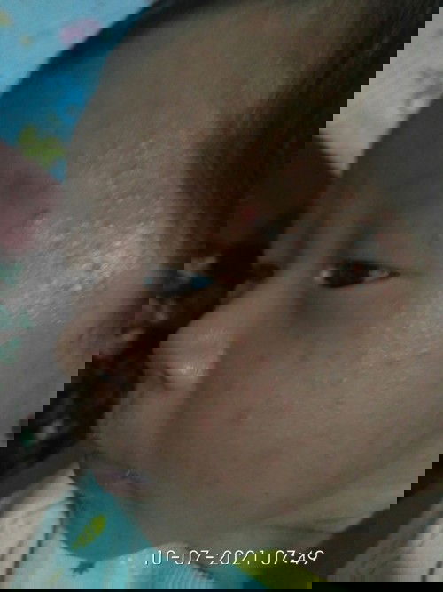 Bruntusan diwajah bayi