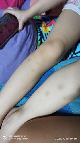 bruses on leg of my child