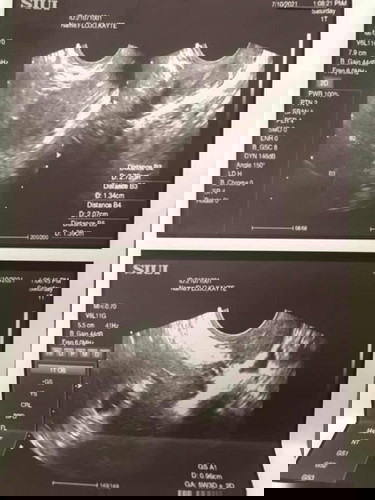 5weeks pregnant, pero wala pang heartbeat at di pa kita si baby :( nawawalan ako pag asa
