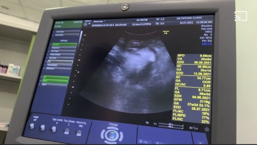 แม่ไปทีมกรกฎาคมมีอาการอย่างไรกันบ้างคะ เริ่มหาวิธีเร่งคลอดกันรึยัง ?