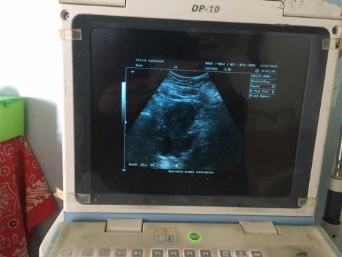 Ada yang pernah ngalamin ndak bun, usia kehamilan udah 9mnggu mnurut hpht tpi di usg belum kelihatan janinnya?