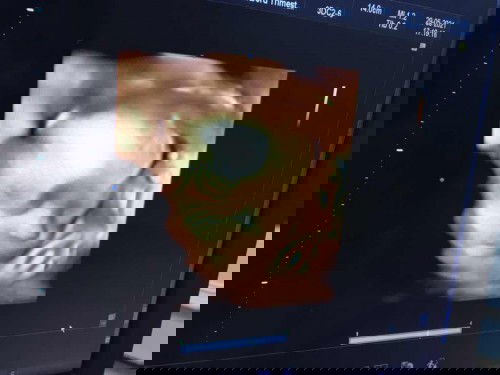 มีใครเป็นเหมือนบ้านนี้บ้าง 34 Week ยังไม่ทราบเพศลูก555.  4มิติก็ได้เห็นน้องหนีบตลอด