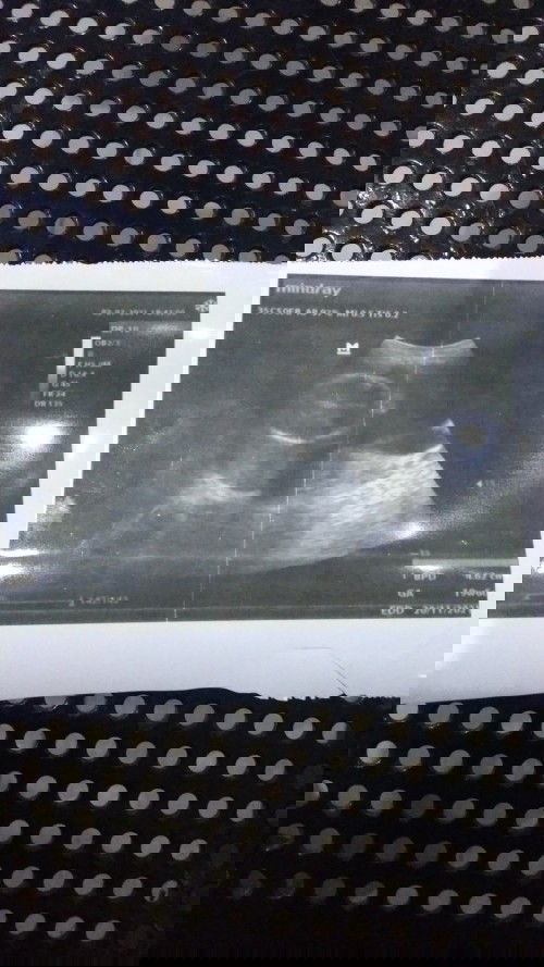 Kehamilan yang Tak Terduga