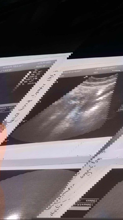 Tespek negatif tapi dokter bilang hamil