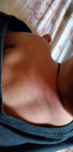 rashes ni baby