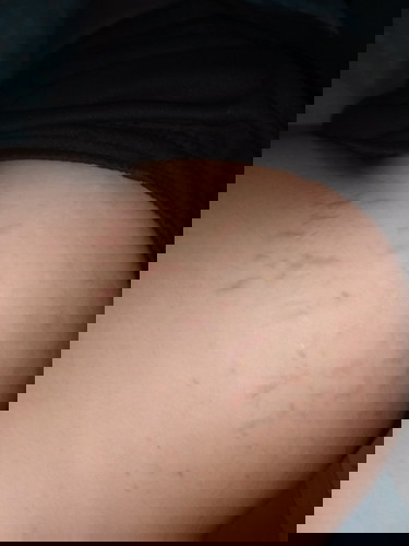 ท้องยังไม่แตกแต่สะโพกไปแล้วจ้า🥲
ไม่แน่ใจว่าเป็นเพราะผ้าที่ใส่หรือสะโพกขยาย