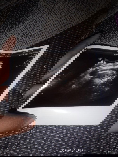 usg habis pendarahan