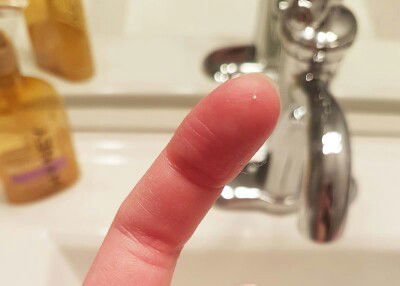 Butiran asi penyebab asi tersumbat