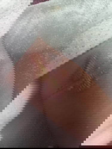 ผลของการเจาะเลือด